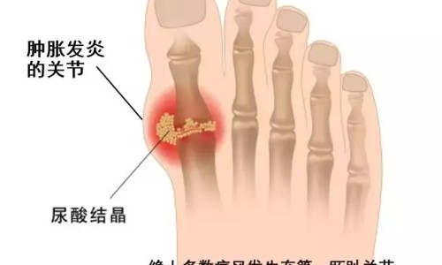 哮喘病人可以拔火罐吗为什么-权威哮喘能拔火罐吗平台,分享专业哮喘能拔火罐吗知识_哮喘病人可以拔火罐吗网